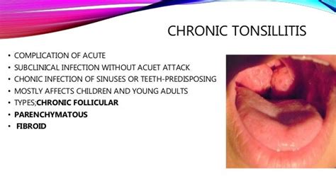 Adenoidsacute And Chronic Tonsillitis
