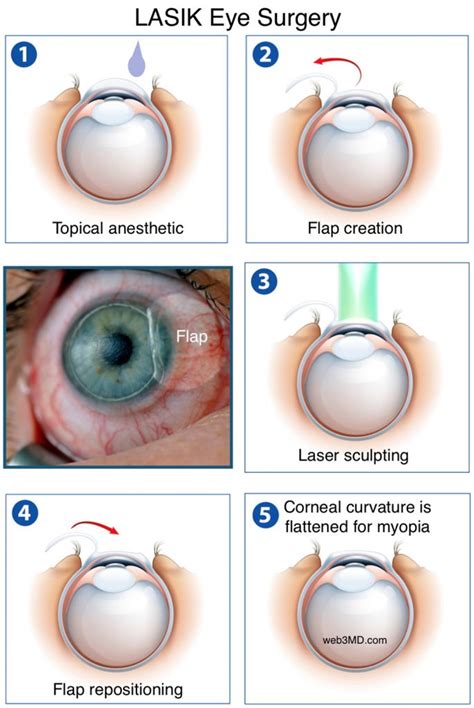 Lasik Eye Surgery For Vision Correction At Fort Worth Eye Associates
