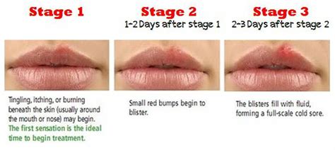 Herpes Symptoms And Stages