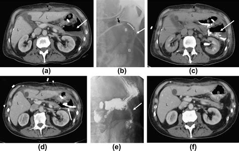 Post Surgical Enteric Fistula Treatment With Image Guided Percutaneous