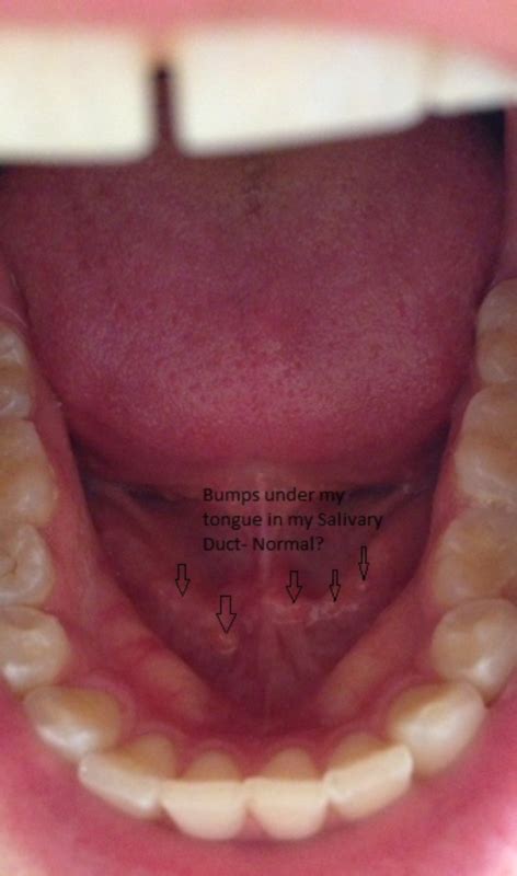 Herpes Under Tongue