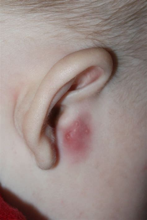 Swollen Lymph Nodes In Front Of Ear Pictures Picturem