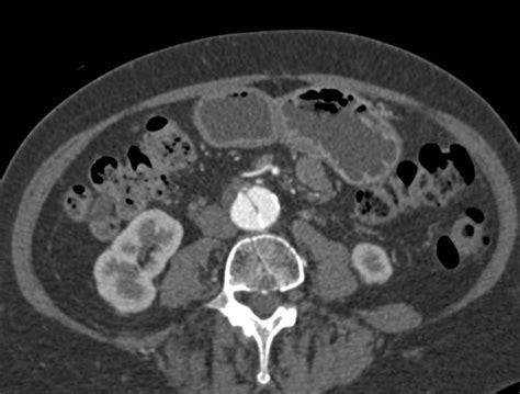 Abdominal Aortic Aneurysm And Focal Dissection Vascular Case Studies
