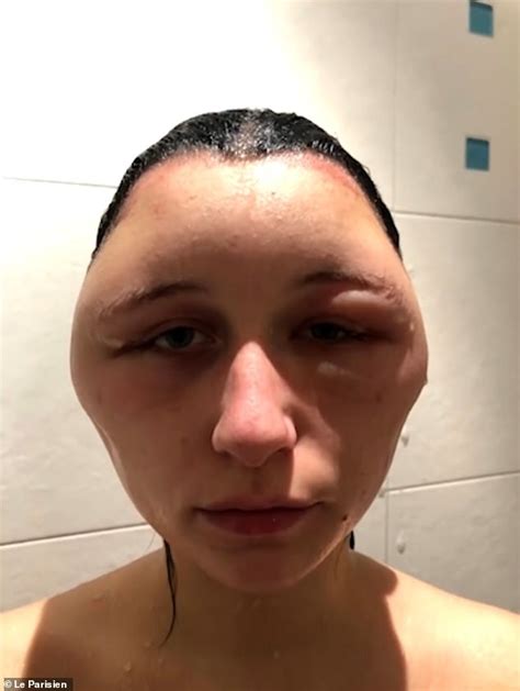 Womans Severe Allergic Reaction To Hair Dye Saw Her Head Almost Double