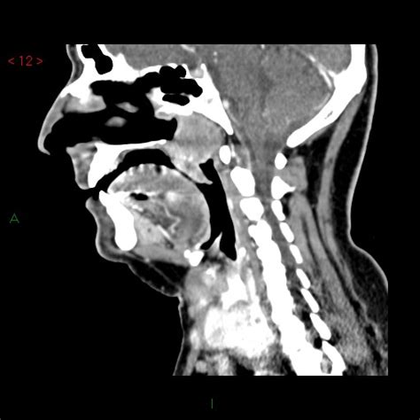 Nasopharyngeal Lymphoma Image