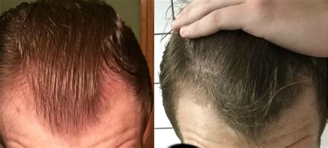 Remember in many cases you may not notice a big difference because finasteride is primarily sliding down your hair loss which is visually tough to see at times. Results from taking finasteride and minoxidil (Photo from ...