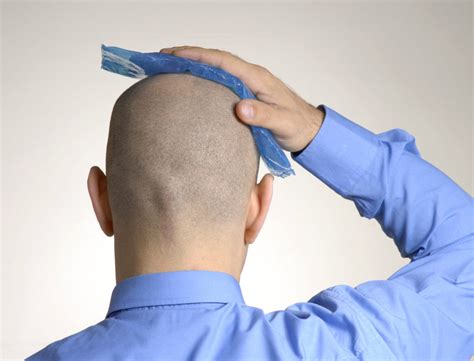 Have Scientists Found A Baldness Cure New Breakthroughs Possible