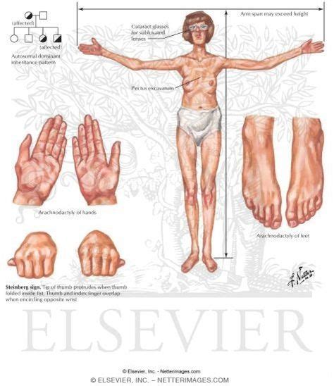 Marfan Syndrome Genetic Disorder Marfan Syndrome Syndrome Ehlers Danlos Syndrome
