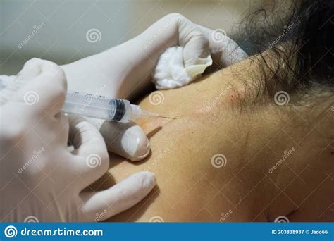 Neural Therapy Injection In Neck Stock Image Image Of Patient Bone