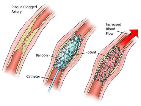 Procedures And Devices Heart Research Australia