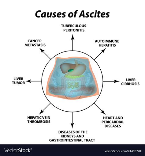 Ascites Free Fluid In The Abdominal Cavity Vector Image