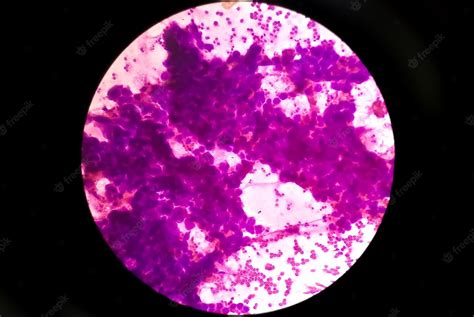 Premium Photo Photomicrograph Of Mucoepidermoid Carcinoma Of Parotid