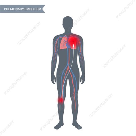 Pulmonary Embolism Illustration Stock Image F0366483 Science