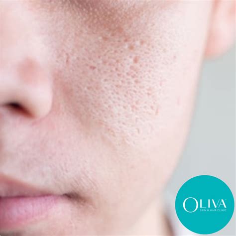 Open Pores Causes Treatments Results And Prevention Tips