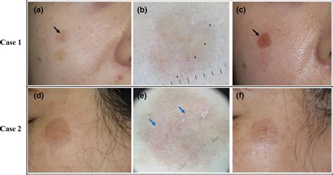 Occurrence Of Postinflammatory Hyperpigmentation After Laser Treatment