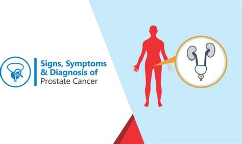 Signs Symptoms And Diagnosis Of Prostate Cancer Shifa International Hospital