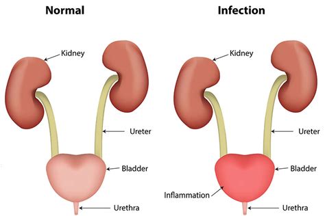 Urinary Tract Infection Symptoms And Treatments Of Urinary Tract Infection Mediologiest