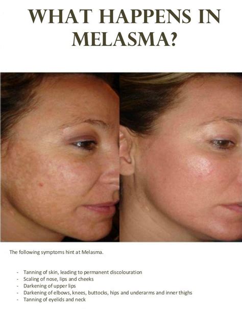 The Way You Designed Best Treatment Melasma Face ~ Renewal Skin
