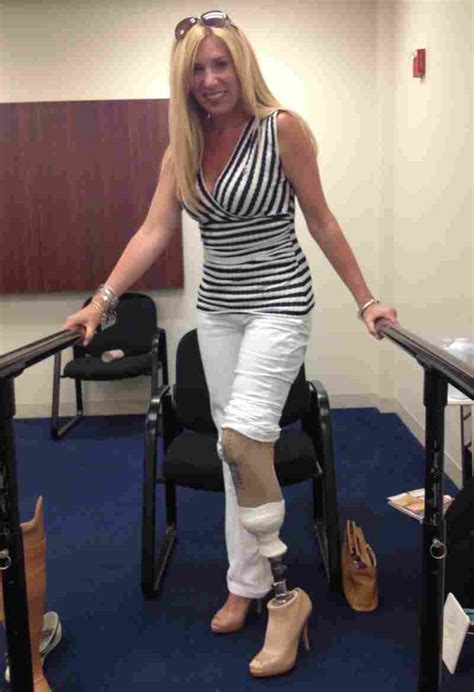 After Losing A Leg Woman Walks On Her Own — In 4 Inch Heels Npr