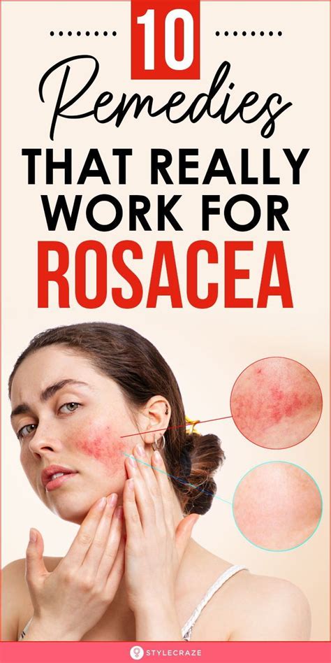 10 Natural Remedies To Manage Rosacea Types Symptoms And Causes In