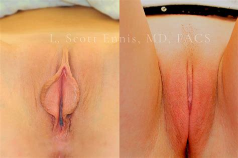 Labiaplasty Before After Photos Ennis Plastic Surgery In Boca Raton