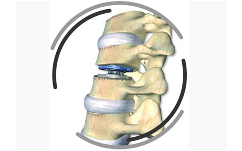 Cervical Disc Arthroplasty Spinal Surgery News