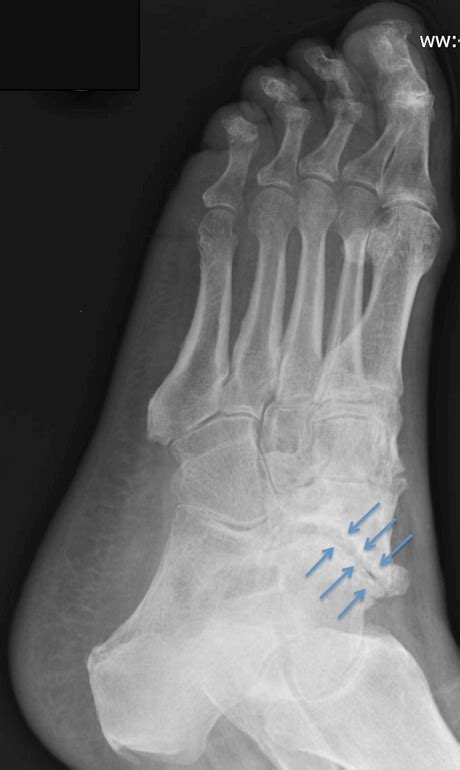 Talonavicular Arthitis Arthritis Of The Talonavicular Joint