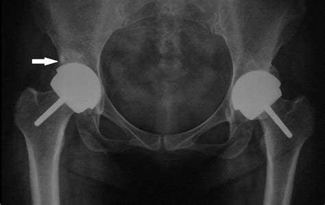 Resurfacing Arthroplasty For Hip Dysplasia Bone And Joint