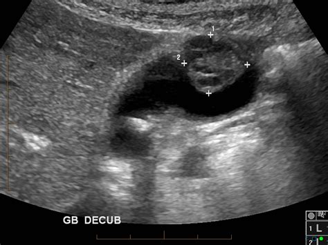Gallbladder Carcinoma Image