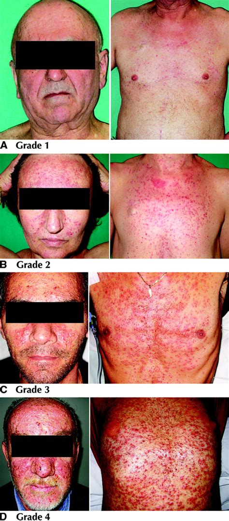 Management Of Skin Toxicity Associated With Cetuximab Treatment In