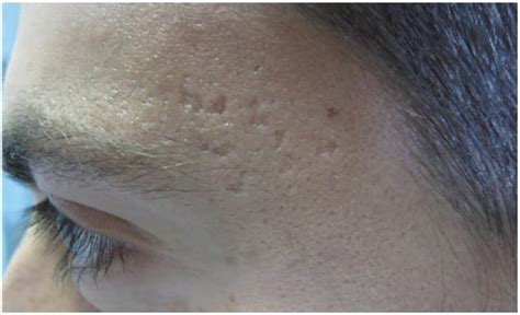 The Different Types Of Acne Scars With Pictures Andrea Catton Laser