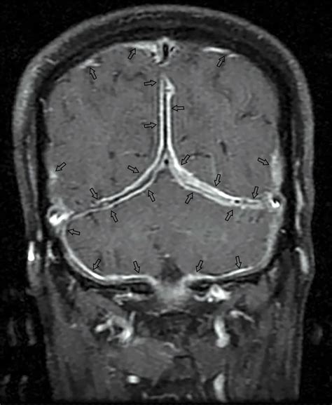 Cureus Tuberculous Hypertrophic Pachymeningitis