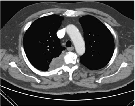Ct Thorax With Contrast Axial View Showing Right Paraspinal Soft