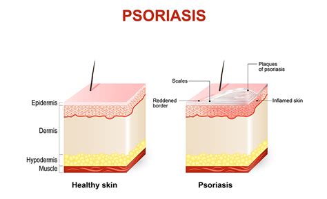 The Truth About Psoriasis