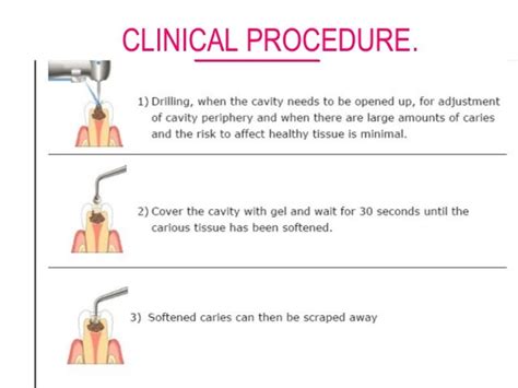 Chemomechanical Caries Removal Carisolv