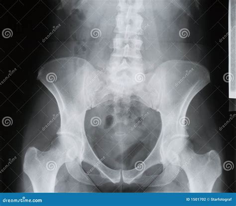 Backbone Pelvis Socket Of Hip Joint Thigh Bone X Ray Osteoporosis