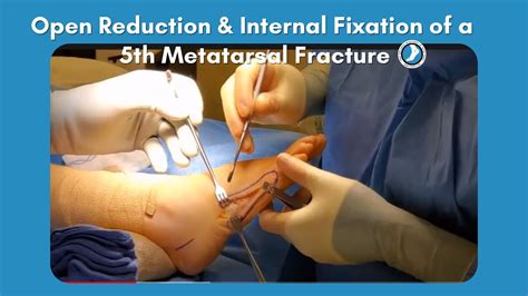 Open Reduction And Internal Fixation Of A 5th Metatarsal Fracture Youtube