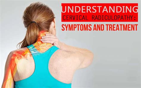 Symptoms Treatment Of Cervical Radiculopathy CopperJoint