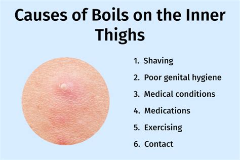 What Causes A Boil In The Pubic Area Treatment Causes Prevention