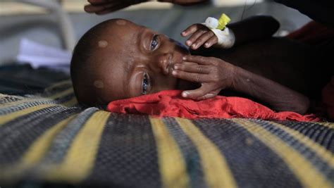 Somália Médicos Sem Fronteiras Lutam Contra Desnutriçã O De Crianças Na Tragédia Humanitári A