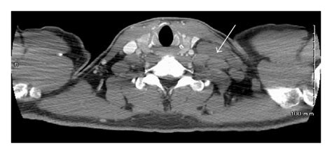 Ct Scan Of The Neck With Left Supraclavicular Lymphadenopathy Arrow