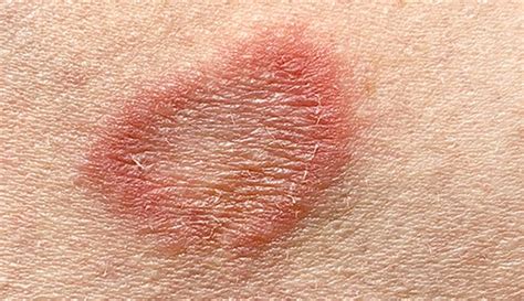 Ringworm Tinea Corporis What It Looks Like Causes Treatment