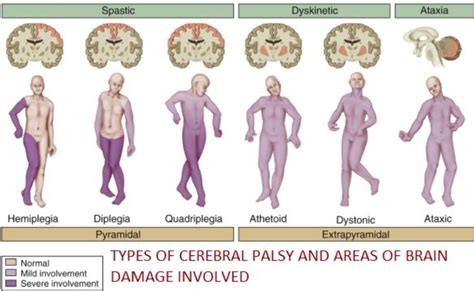 The most common etiology of cerebral palsy is birth asphyxia which is referred to as ischemia or an infarction resulting from a decrease in oxygenation to the brain and subsequent neurological damage. Signs & Symptoms - Cerebral Palsy