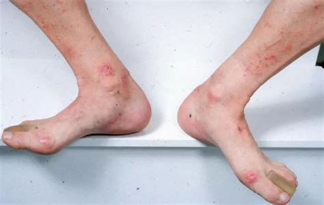 Dermatitis Herpetiformis Celiac Disease Rash Photos Gluten Rash