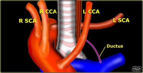 Right Sided Aortic Arch With Anomalous Left Subclavian Artery Diagnostic Imaging Cardiac
