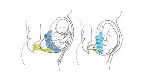 Forward Leaning Inversion Technique For Easier Birth