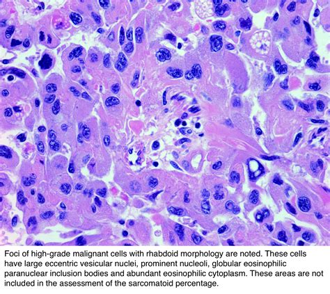 Pathology Outlines Sarcomatoid Renal Cell Carcinoma