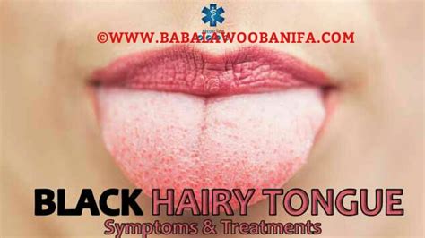 Babalawo Obanifa Herbal Cure For Black Hairy Tongue Black Tongue