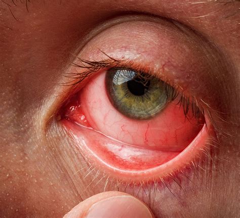 Infected Eye Types Causes And Treatment