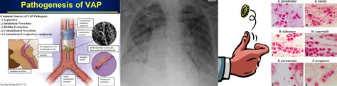 Ventilator Associated Pneumonia Vap Emcrit Project